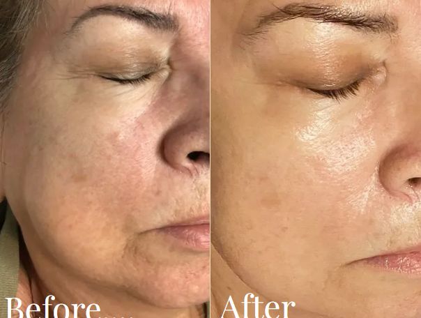 Before and after skin pigmentation treatment