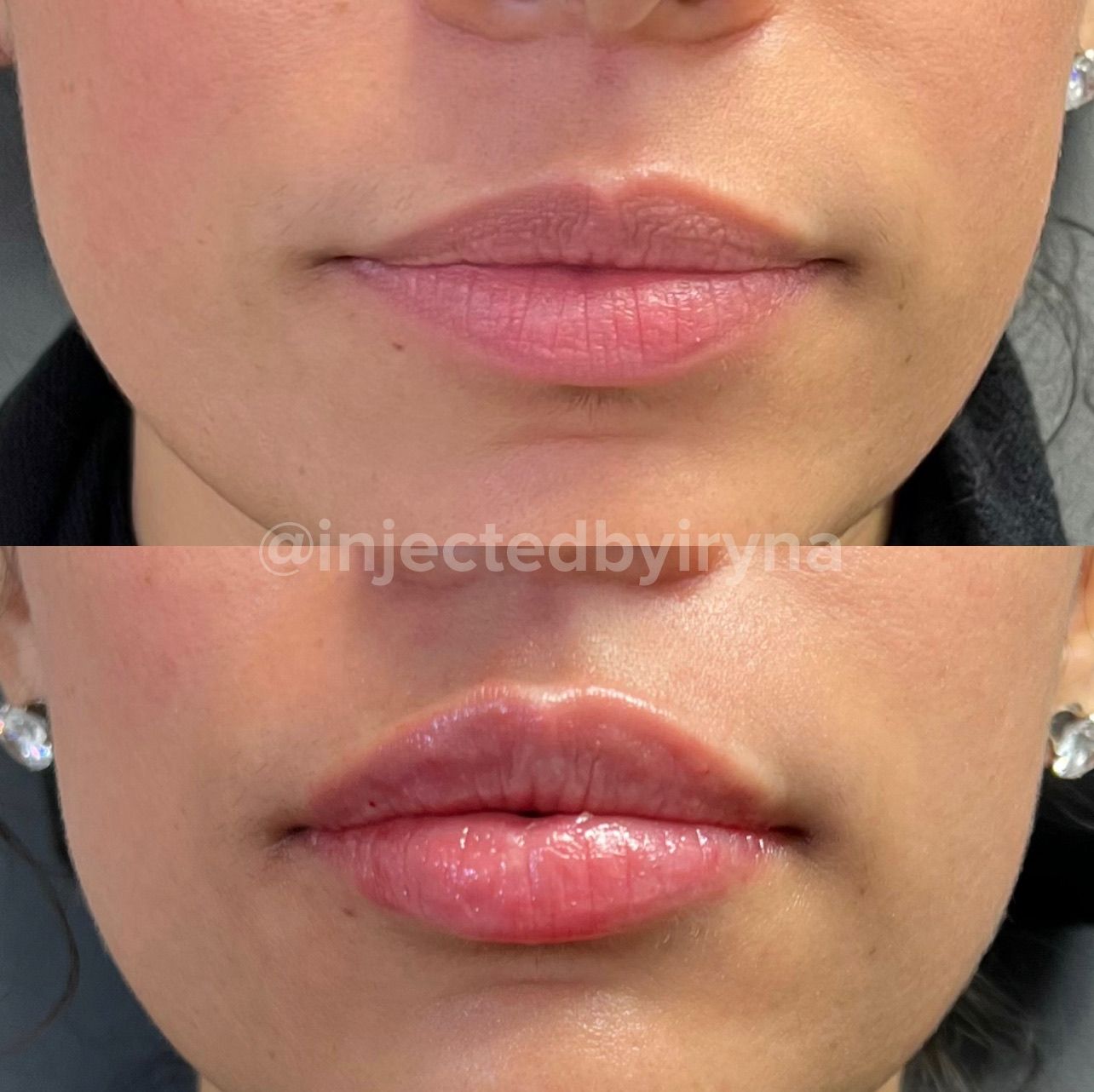 Lip Filler Before and After — Natural Fuller Lips