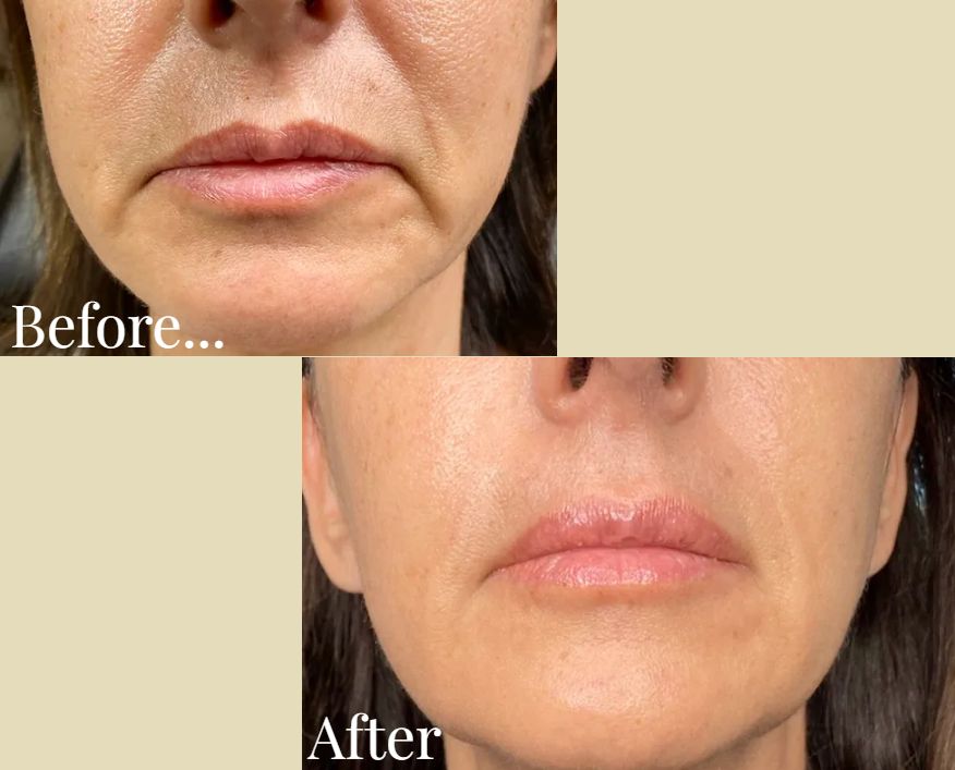 Before and after lip area treatment