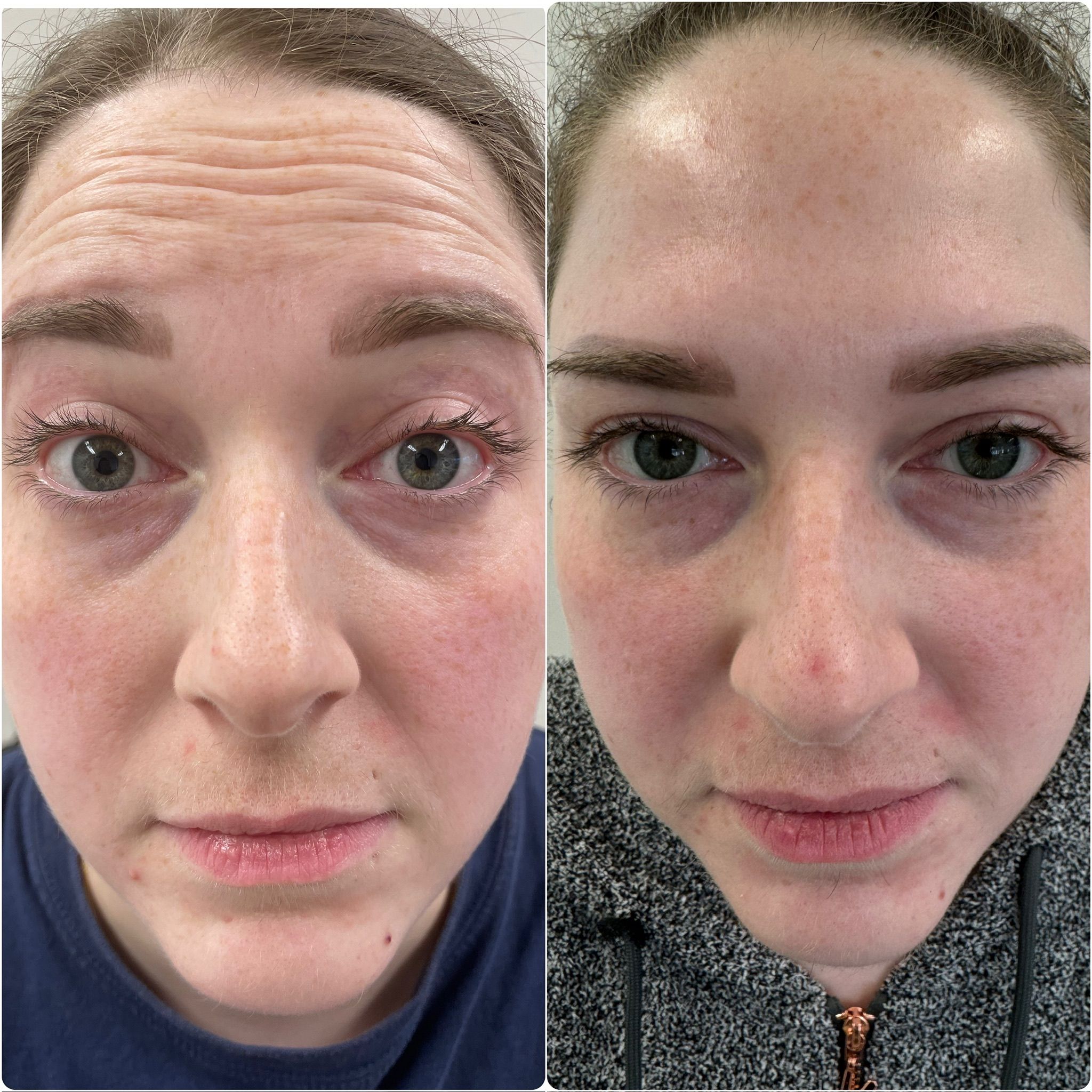 Before and after Botox forehead treatment
