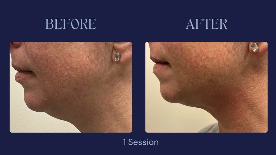 CryoSlim Chin Contour - After