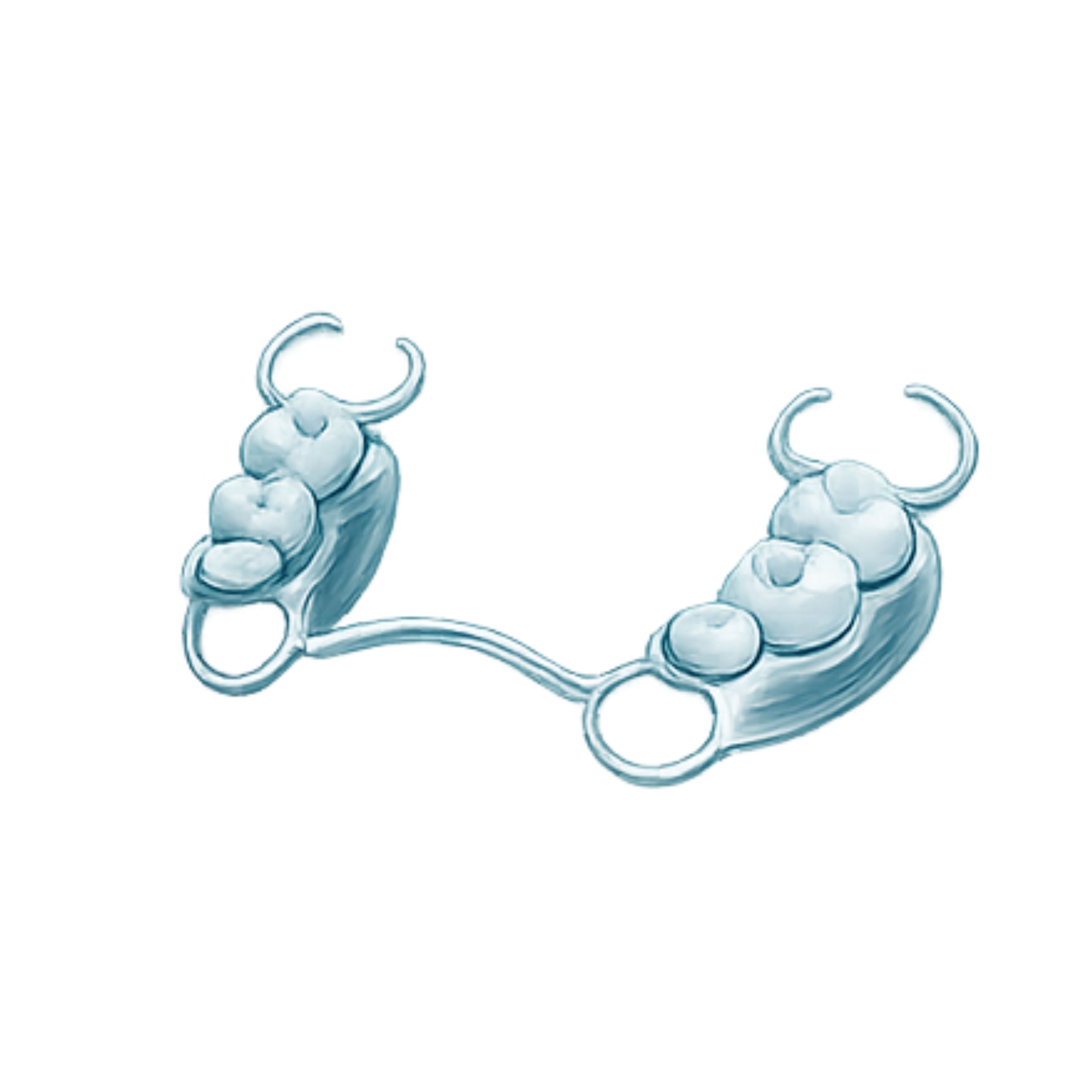 Chrome framework dental appliance