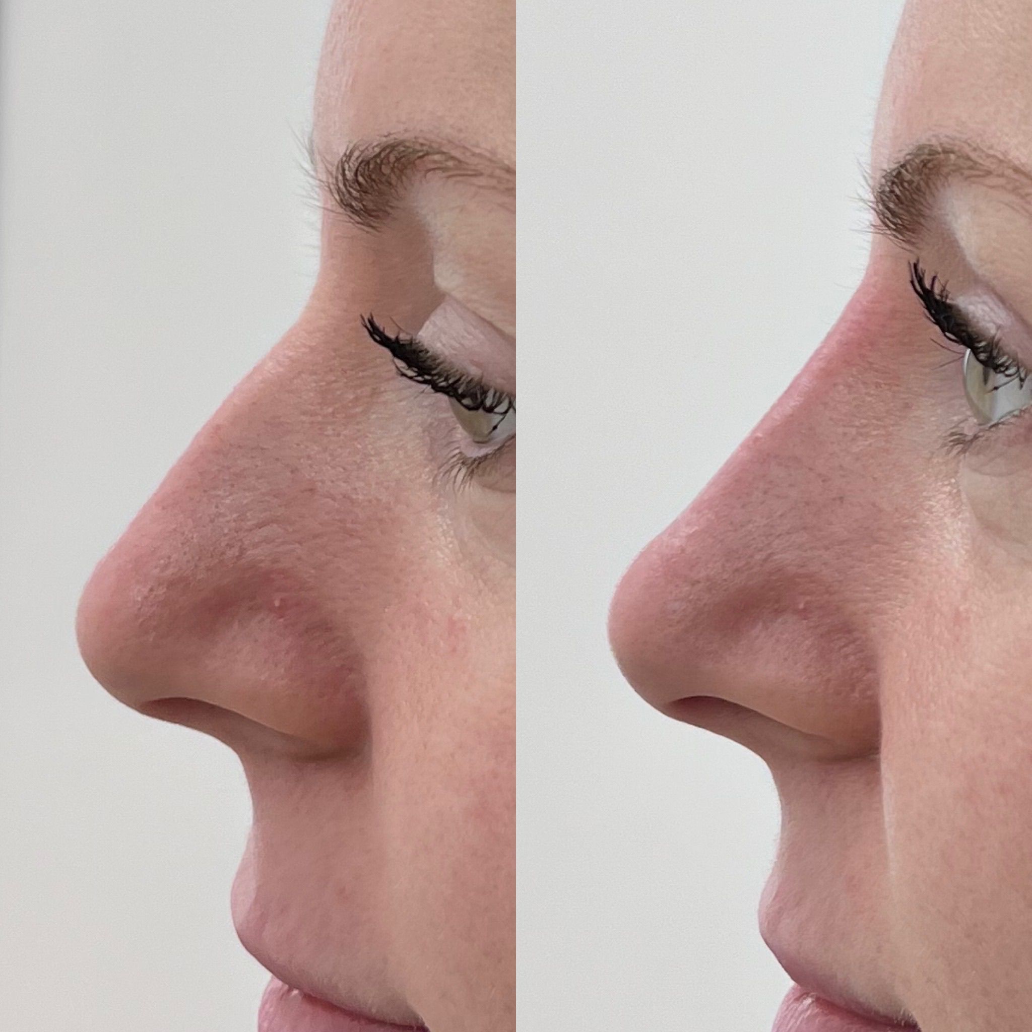 Liquid Rhinoplasty Before and After — Nose Bridge Smoothing