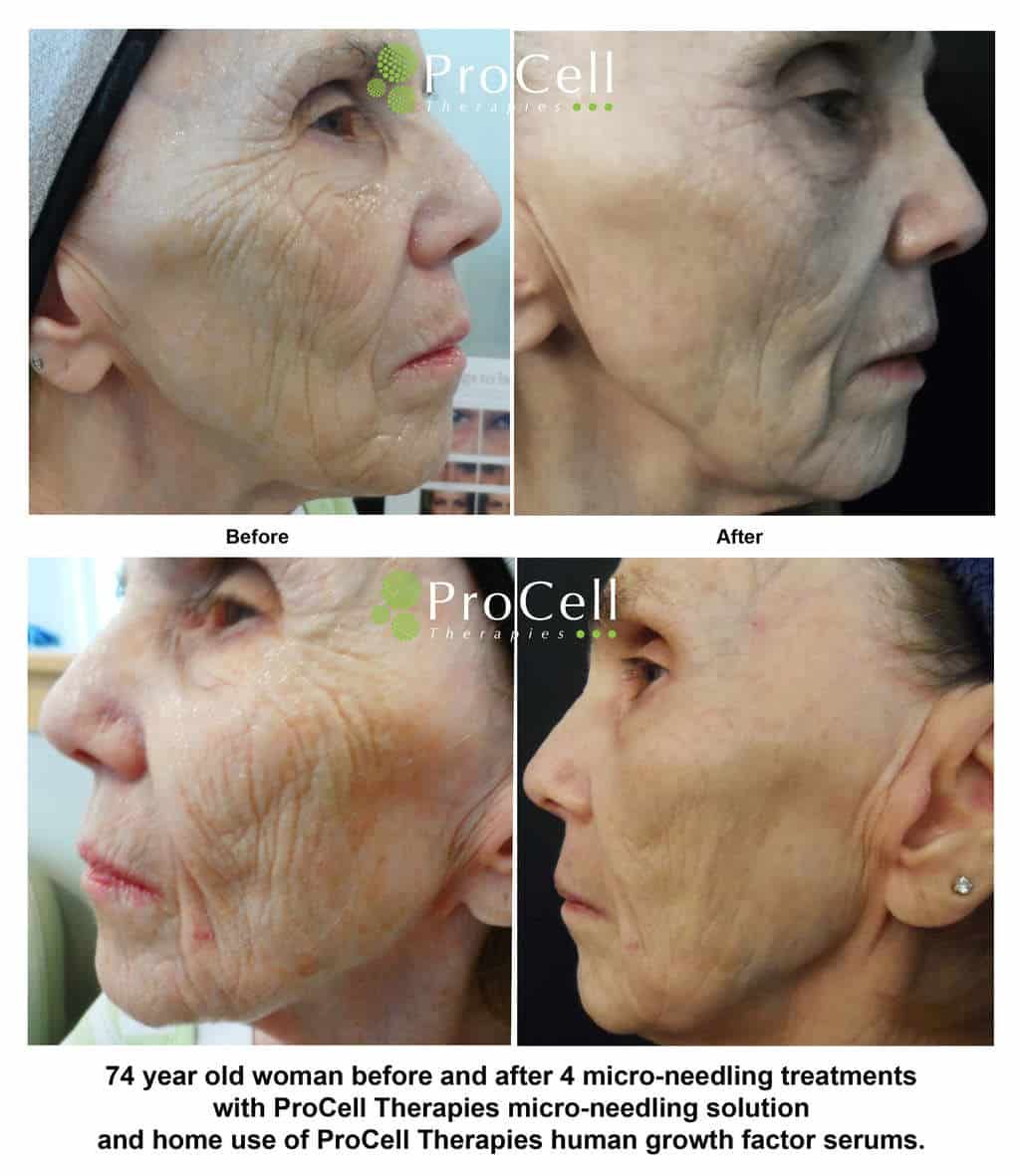 74-year-old patient before and after Procell treatments