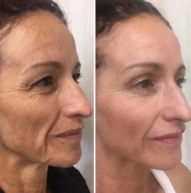 Before and after facial rejuvenation