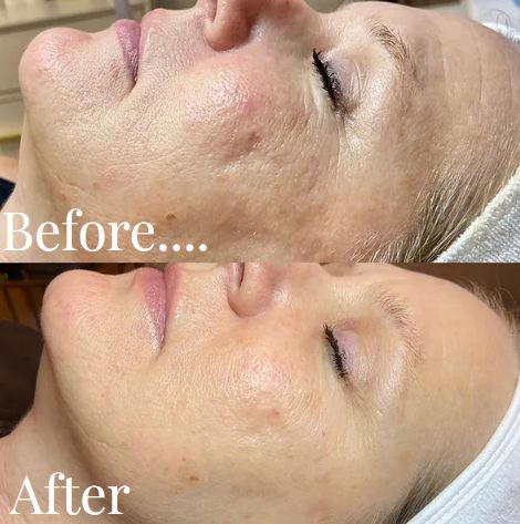 Before and after skin texture treatment