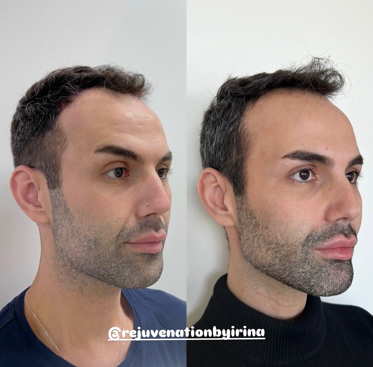Full Facial Balancing Before and After — Cheeks, Jawline, Lips, Chin