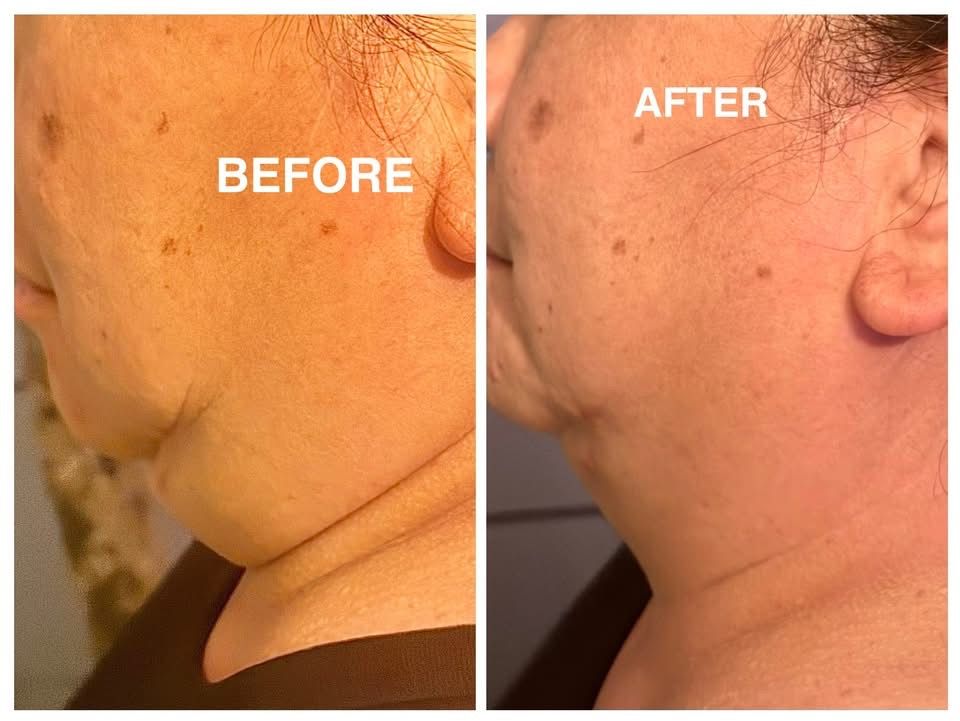 CryoSlim Jawline - After