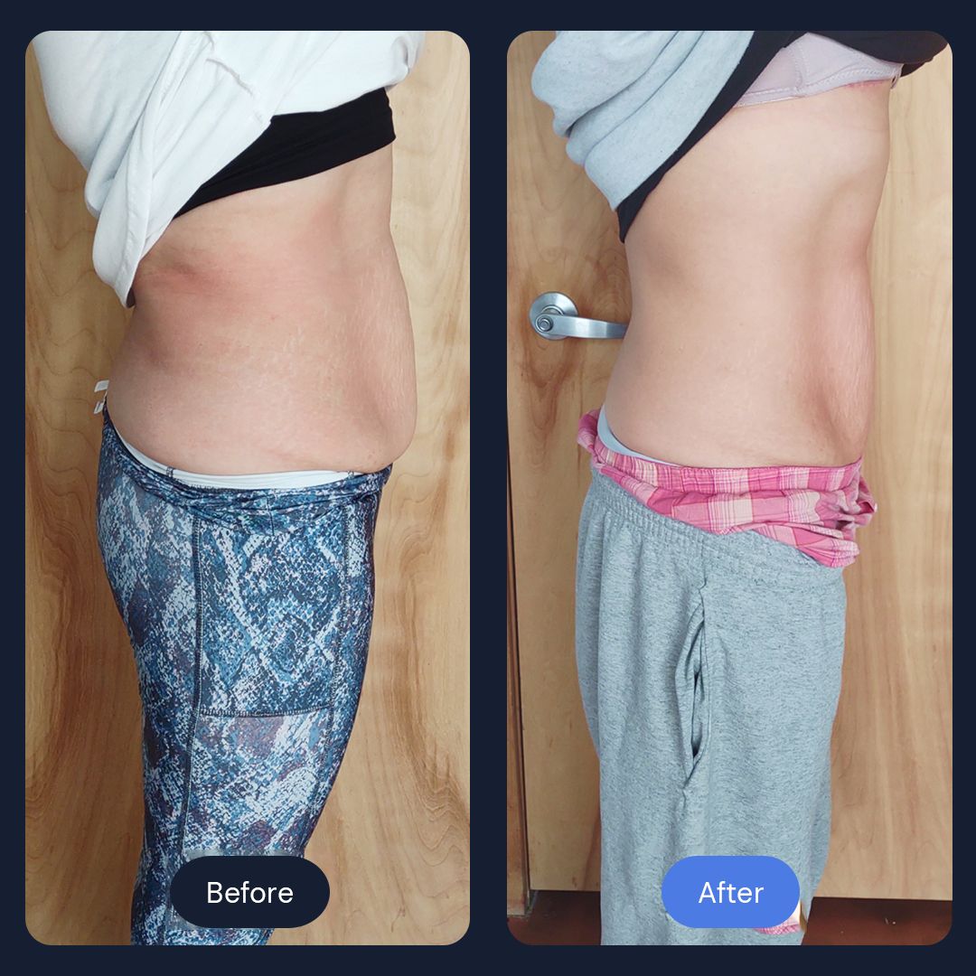 CryoSlim Fat Reduction