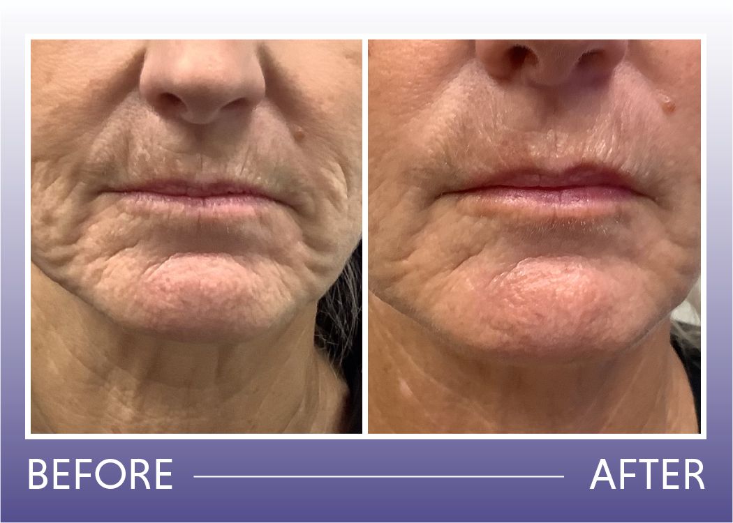 Before and after wrinkle reduction