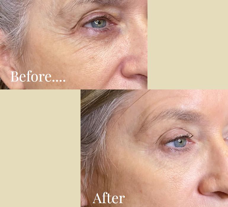 Before and after eye area treatment