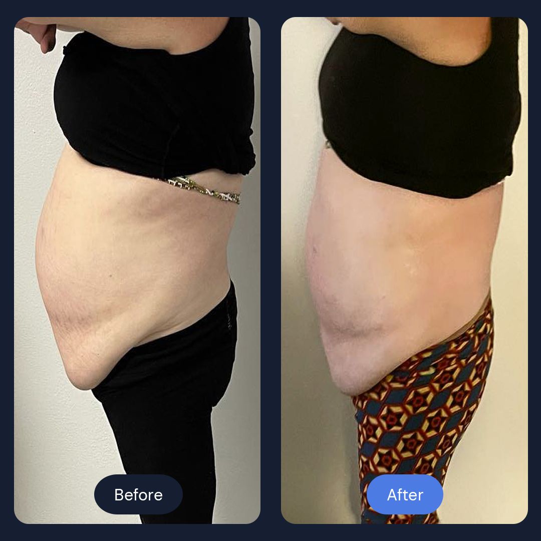 CryoSlim Abdomen - Before