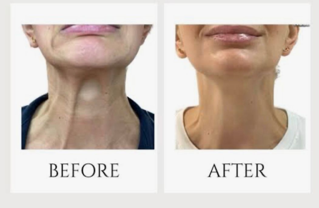 Before and after neck rejuvenation treatment
