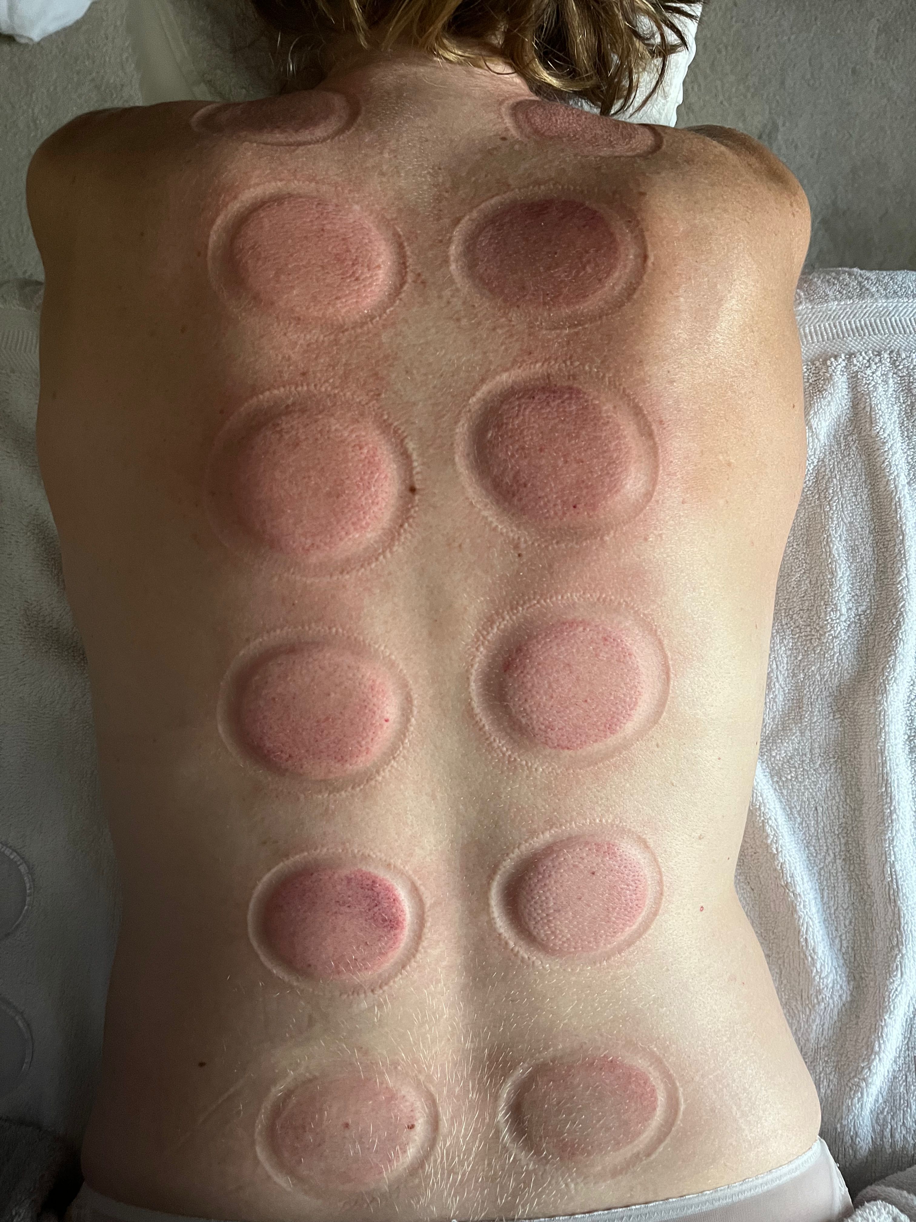 Cupping therapy results showing circular marks on a client's back at Bodyfix Therapy, Longniddry, East Lothian