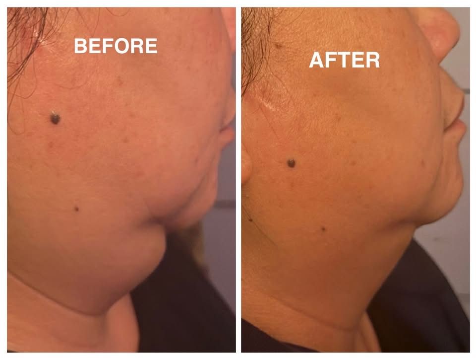 CryoSlim Jawline - Before